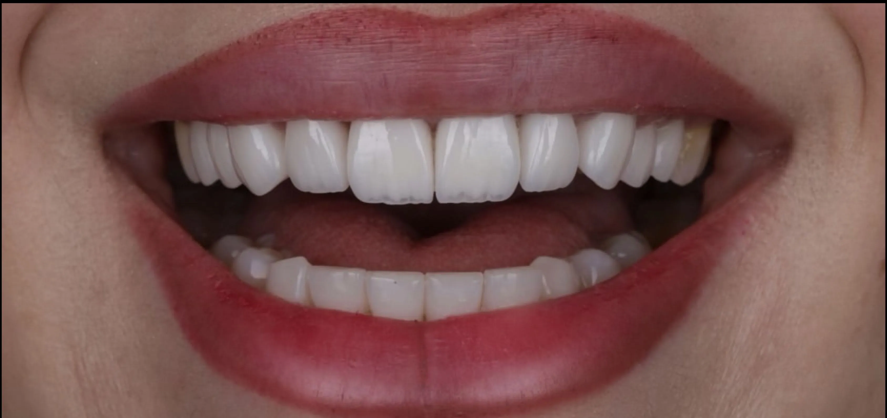 After: finished smile makeover result