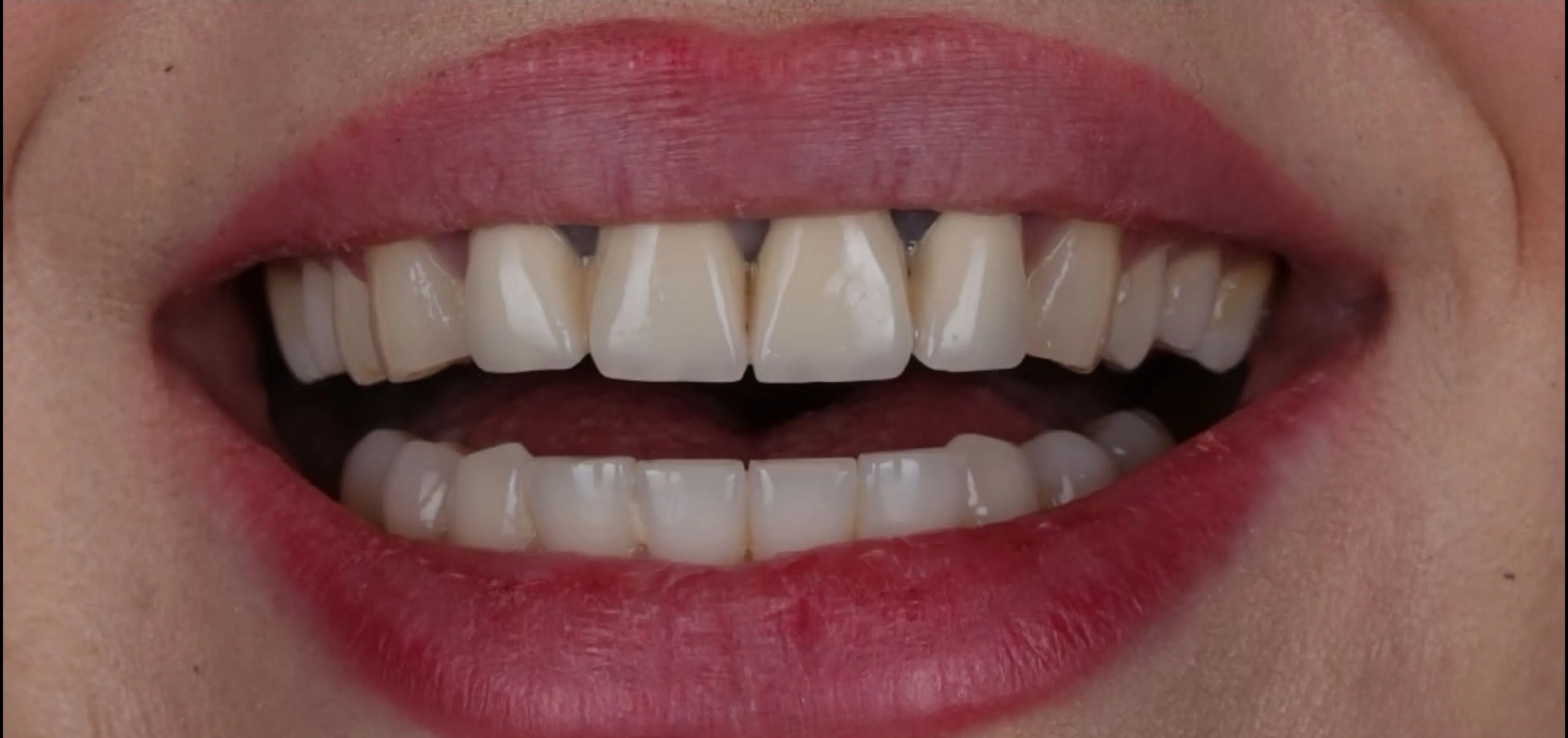 Before: original teeth